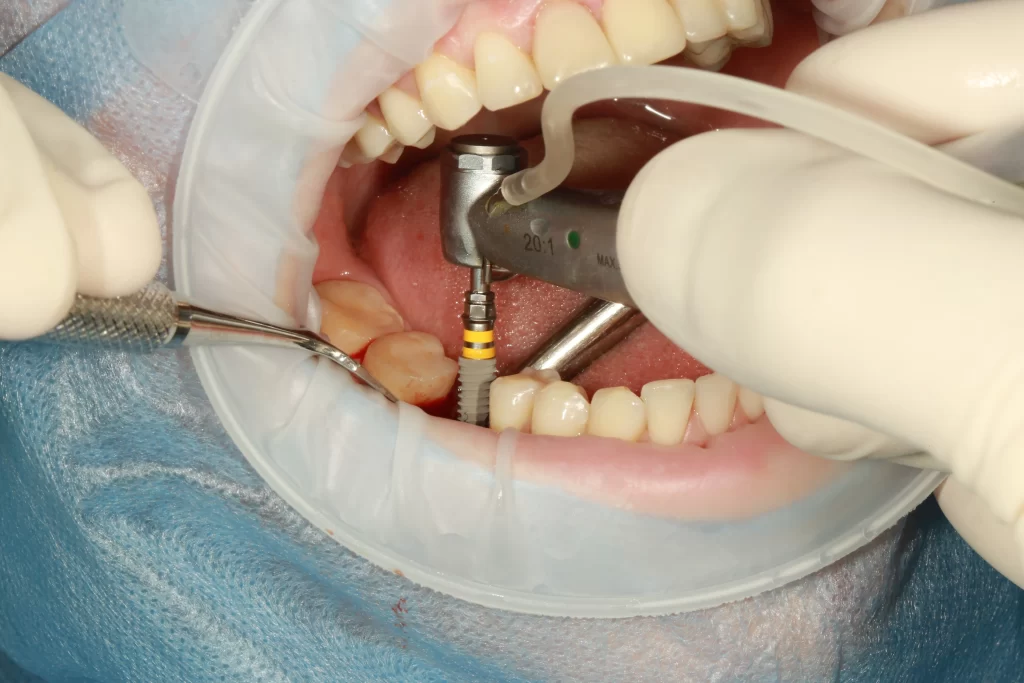 single dental implant treatment