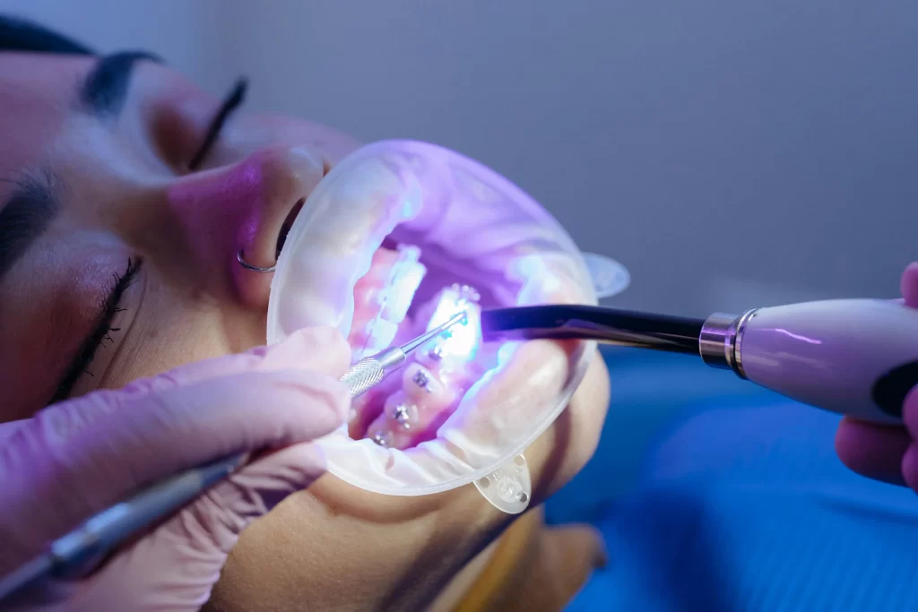 teeth whitening consultation for sensitive teeth