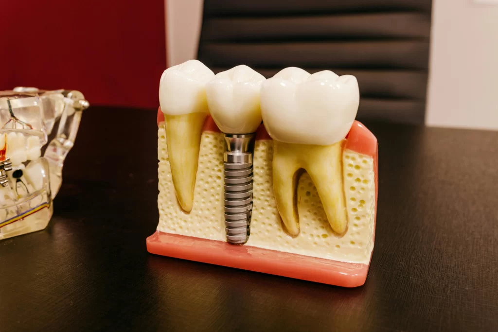 duración carillas dentales – mantenimiento y longevidad